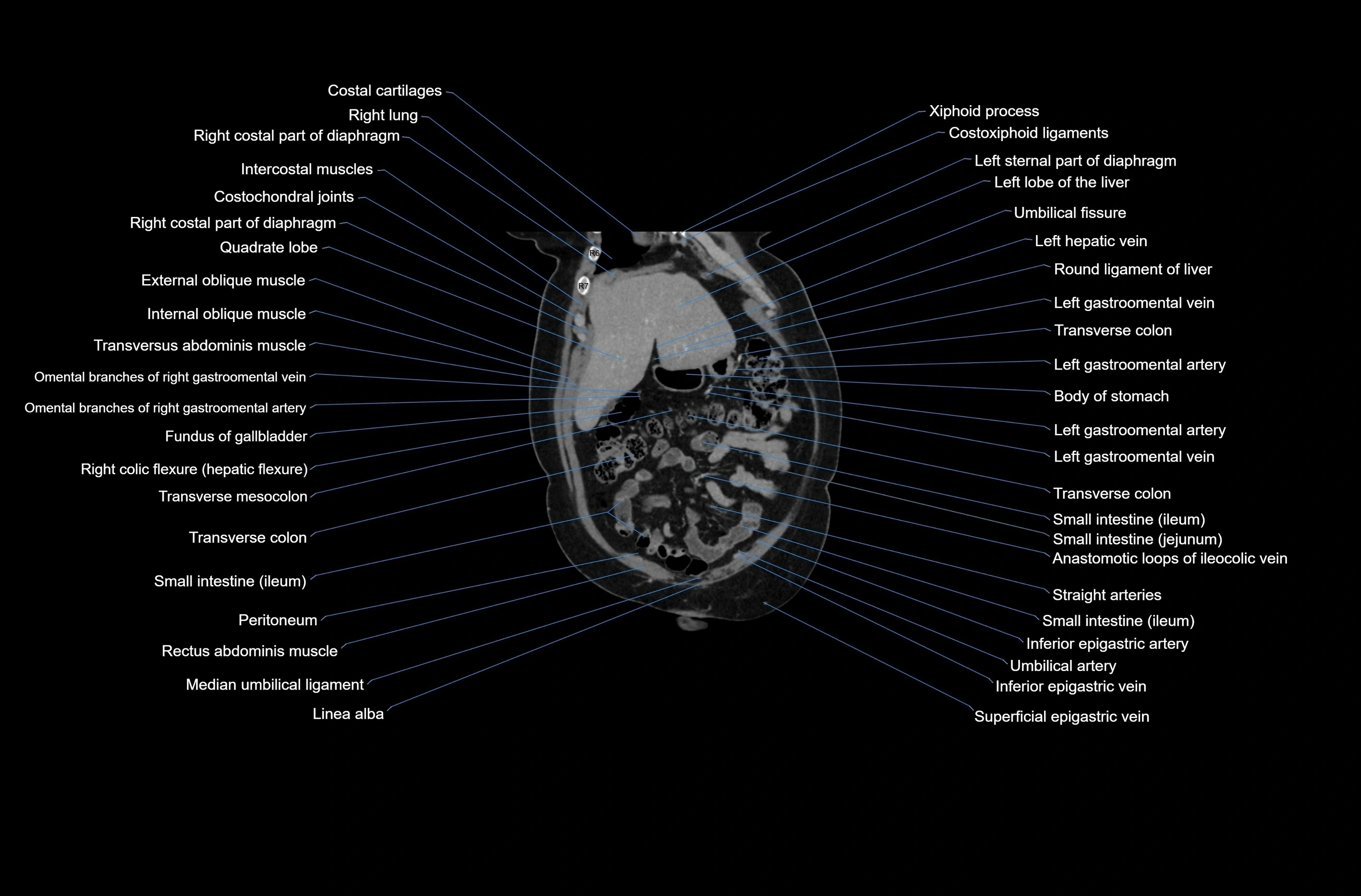 CT abdomen coronal cross sectional anatomy labelled radiology image-00017.webp